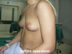 plastic-surgery-breast-augmentation 